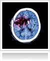 Jury Awards $44.1 Million to Brain Injury Victim
